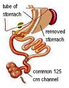 Duodenal Switch - DS